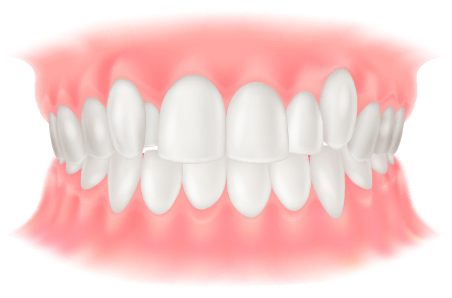叢生(そうせい)(乱ぐい歯・八重歯)